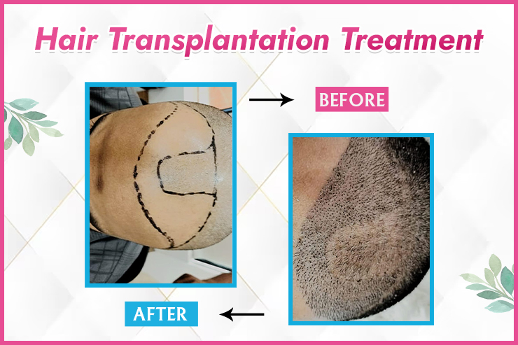 amista before and hair transplantation